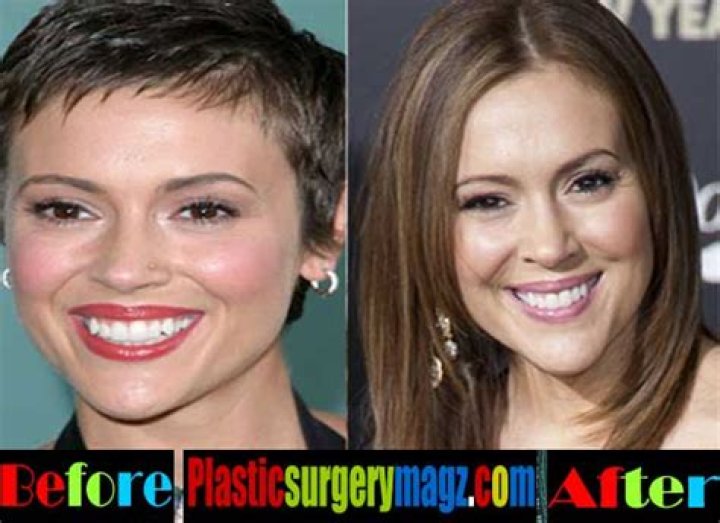Alyssa Milano Breast Augmentation Plastic Surgery Before and After