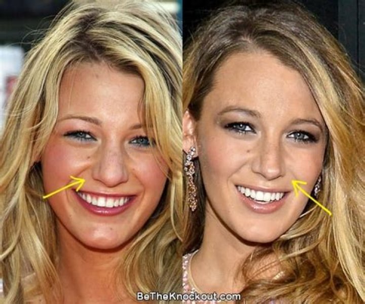 Blake Lively Breast Implants & Nose Job Plastic Surgery – Before and After