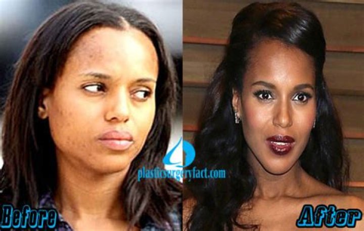Kerry Washington Nose Job Plastic Surgery Before and After