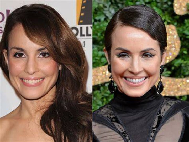 Noomi Rapace Plastic Surgery Before and After